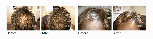 laser-hair-loss-treatment-long-island